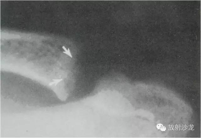 【病例】大块骨质溶解症1例影像表现 【病例】大块骨质溶解症1例影像表现