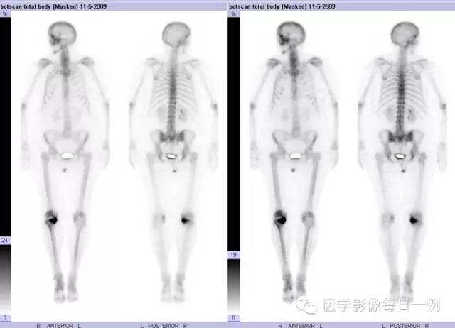 【病例】膝关节自发性骨坏死1例 【病例】膝关节自发性骨坏死1例