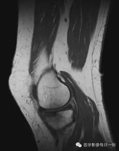 【病例】膝关节自发性骨坏死1例 【病例】膝关节自发性骨坏死1例