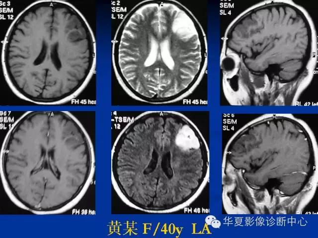 颅脑肿瘤MR诊断与鉴别诊断