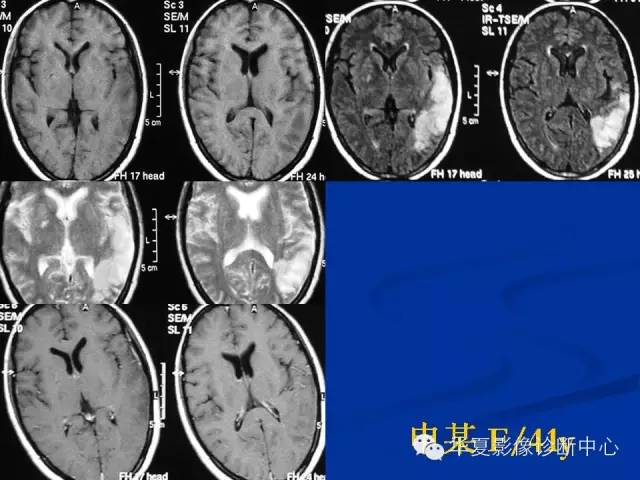 颅脑肿瘤MR诊断与鉴别诊断