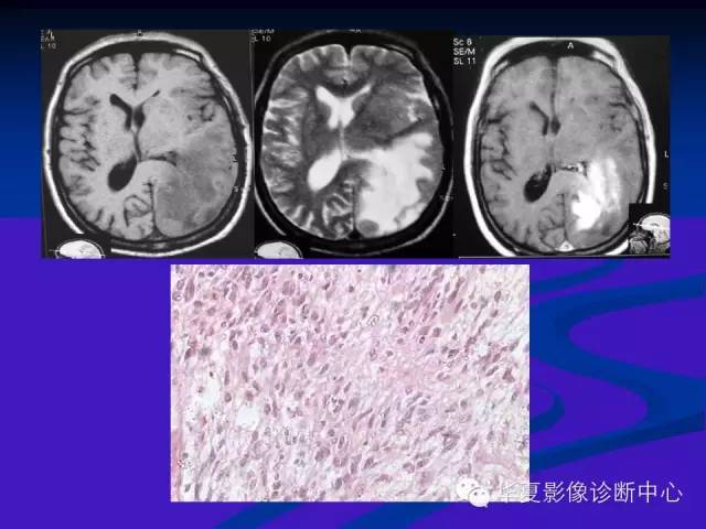 颅脑肿瘤MR诊断与鉴别诊断