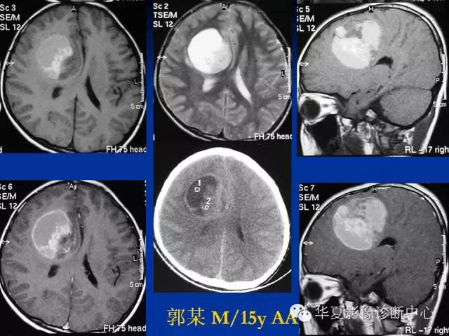 颅脑肿瘤MR诊断与鉴别诊断