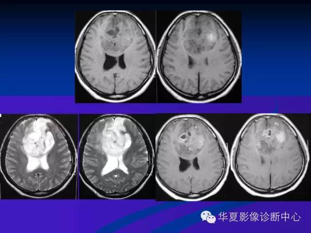 颅脑肿瘤MR诊断与鉴别诊断
