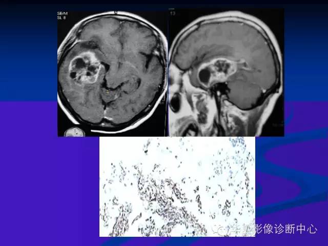 颅脑肿瘤MR诊断与鉴别诊断