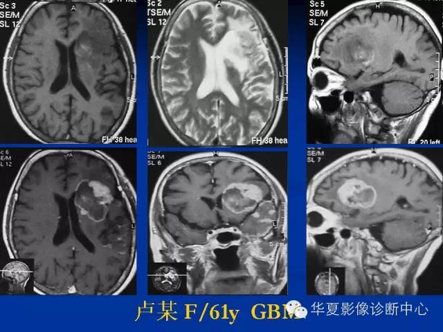 颅脑肿瘤MR诊断与鉴别诊断