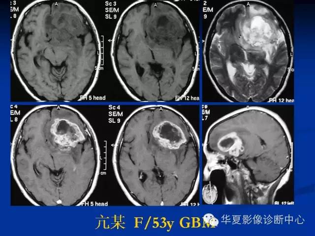 颅脑肿瘤MR诊断与鉴别诊断