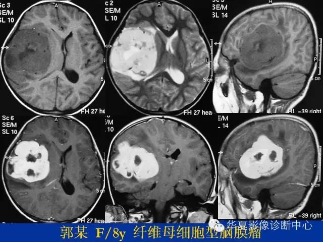 颅脑肿瘤MR诊断与鉴别诊断
