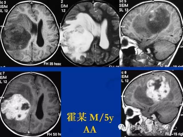 颅脑肿瘤MR诊断与鉴别诊断