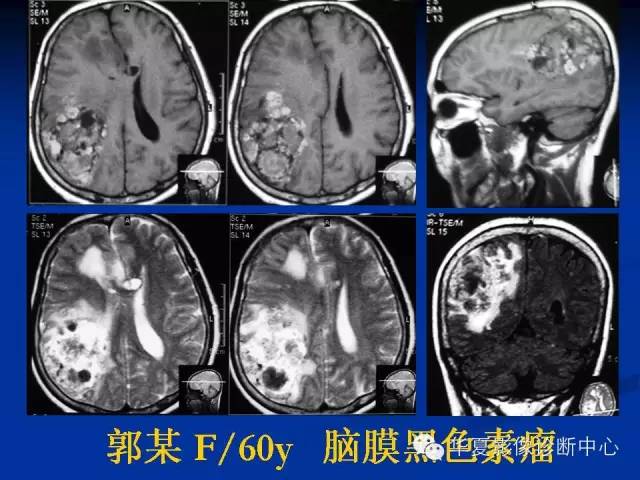 颅脑肿瘤MR诊断与鉴别诊断