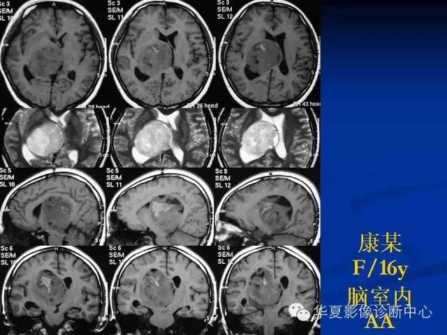 颅脑肿瘤MR诊断与鉴别诊断