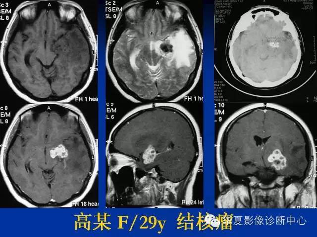 颅脑肿瘤MR诊断与鉴别诊断