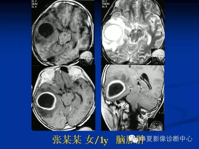 颅脑肿瘤MR诊断与鉴别诊断