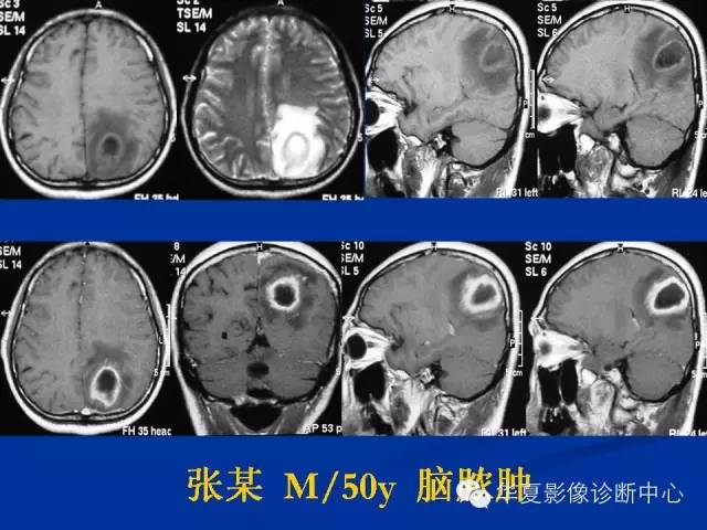 颅脑肿瘤MR诊断与鉴别诊断