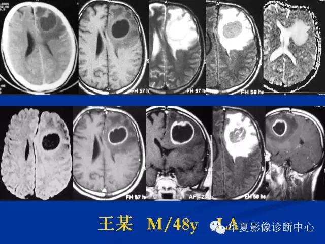 颅脑肿瘤MR诊断与鉴别诊断