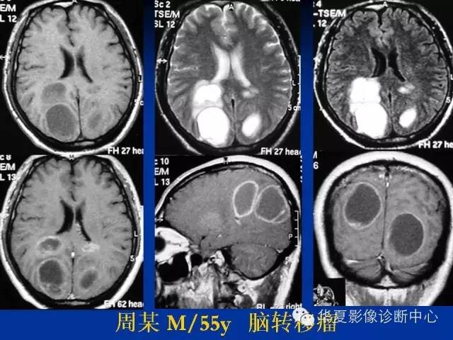 颅脑肿瘤MR诊断与鉴别诊断