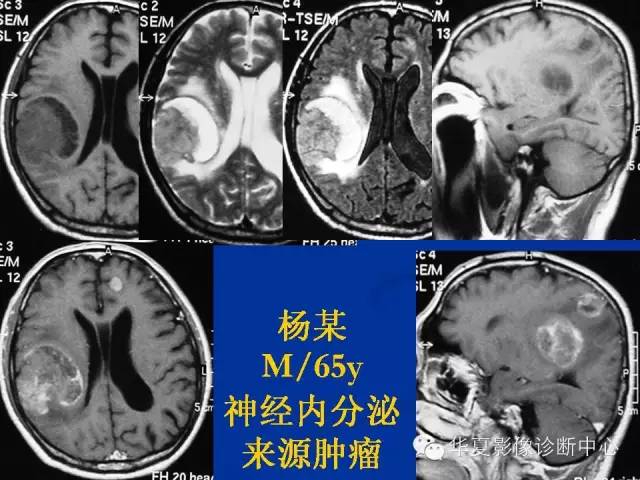 颅脑肿瘤MR诊断与鉴别诊断