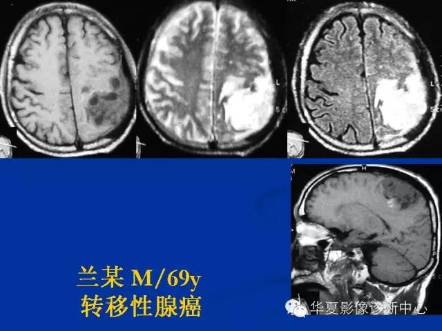 颅脑肿瘤MR诊断与鉴别诊断