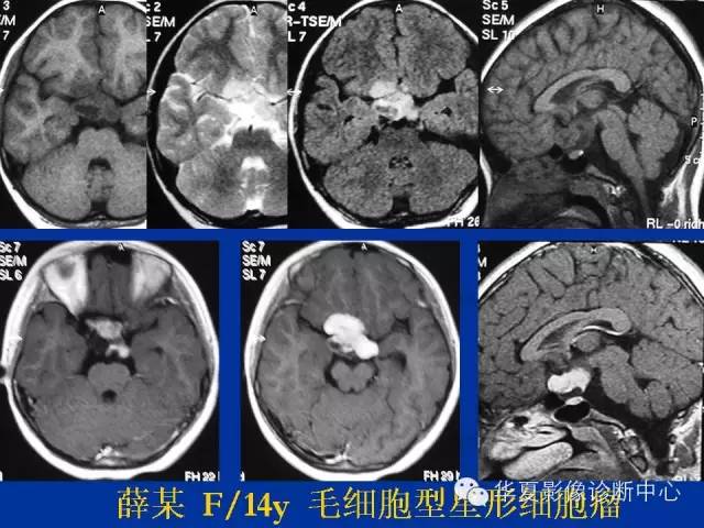 颅脑肿瘤MR诊断与鉴别诊断