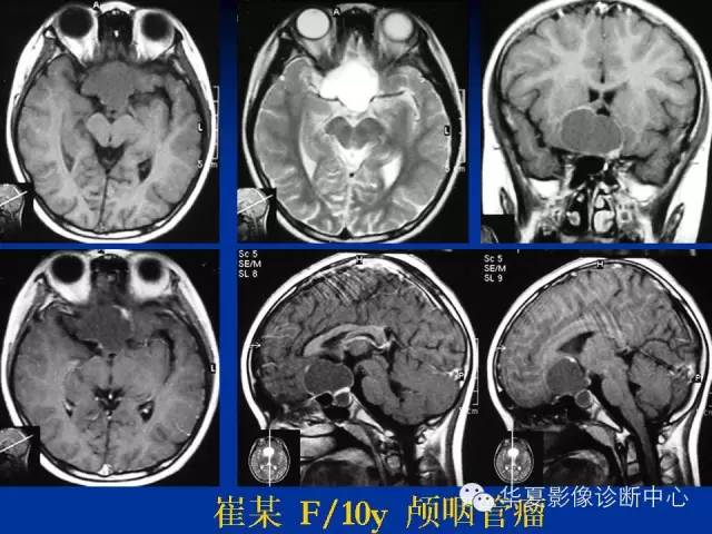 颅脑肿瘤MR诊断与鉴别诊断