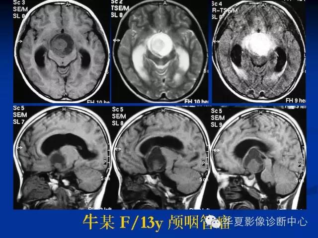 颅脑肿瘤MR诊断与鉴别诊断