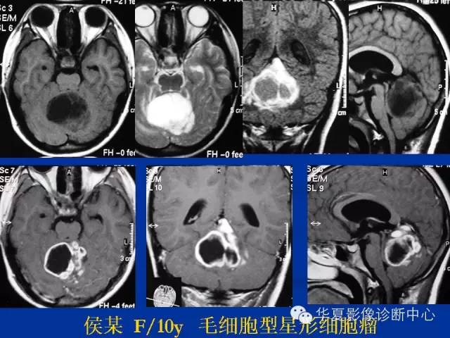 颅脑肿瘤MR诊断与鉴别诊断