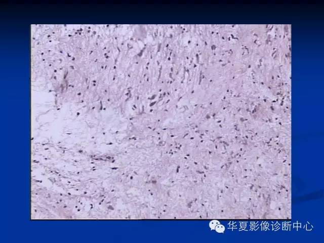颅脑肿瘤MR诊断与鉴别诊断