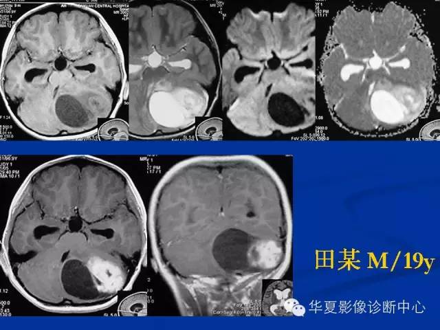 颅脑肿瘤MR诊断与鉴别诊断