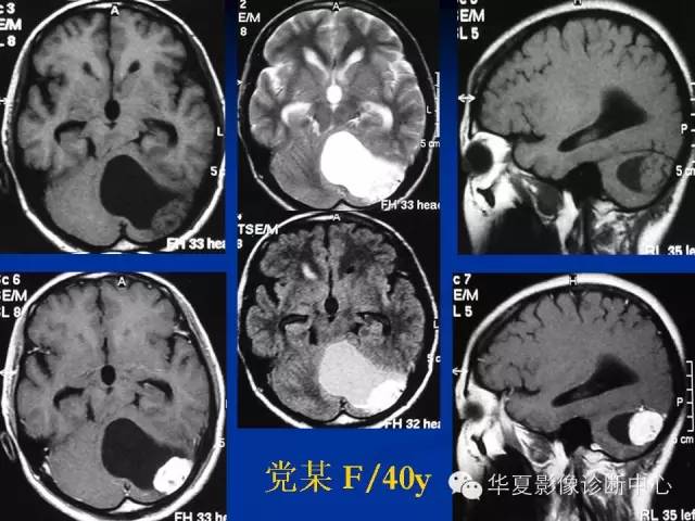 颅脑肿瘤MR诊断与鉴别诊断