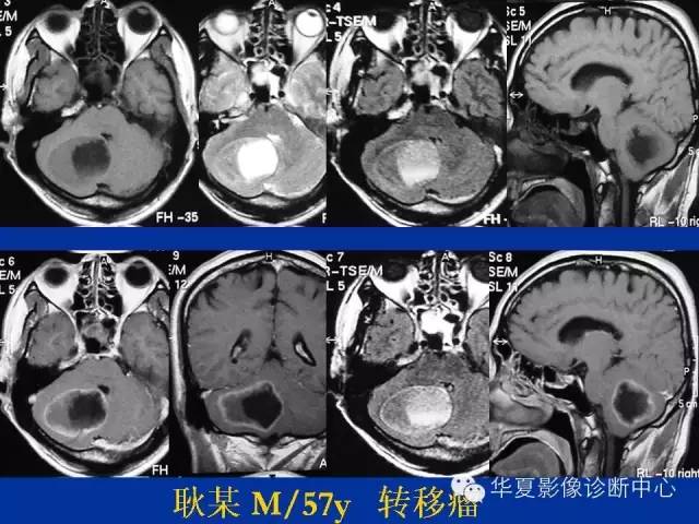 颅脑肿瘤MR诊断与鉴别诊断