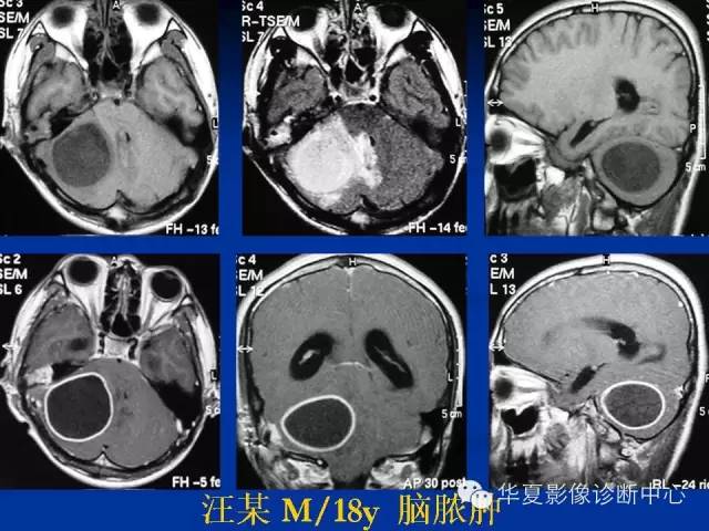 颅脑肿瘤MR诊断与鉴别诊断