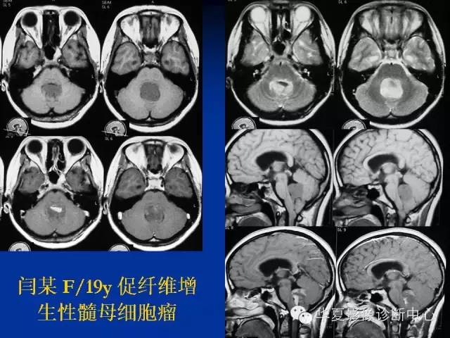 颅脑肿瘤MR诊断与鉴别诊断
