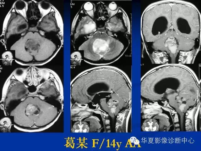 颅脑肿瘤MR诊断与鉴别诊断