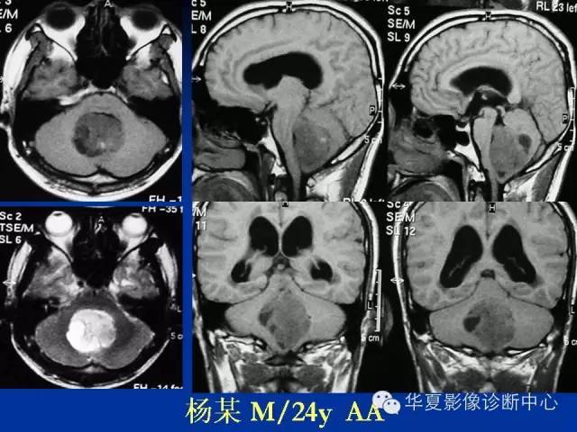 颅脑肿瘤MR诊断与鉴别诊断