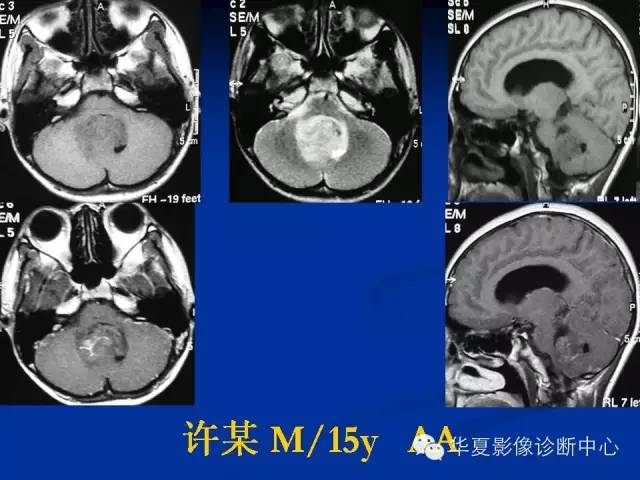颅脑肿瘤MR诊断与鉴别诊断