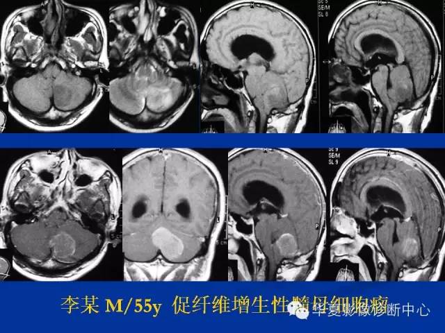 颅脑肿瘤MR诊断与鉴别诊断