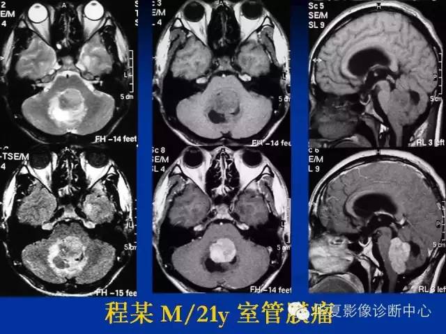 颅脑肿瘤MR诊断与鉴别诊断
