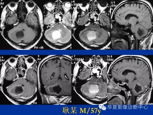 颅脑肿瘤MR诊断与鉴别诊断