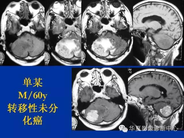 颅脑肿瘤MR诊断与鉴别诊断