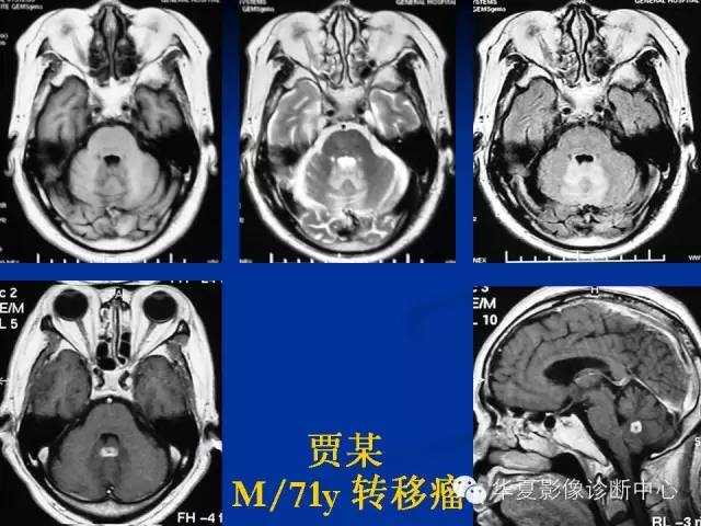颅脑肿瘤MR诊断与鉴别诊断