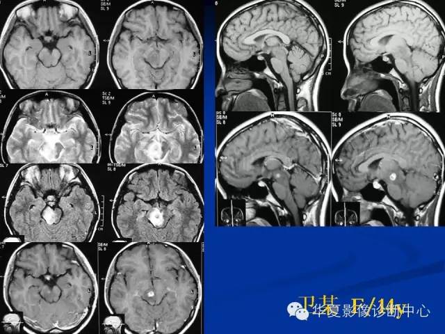颅脑肿瘤MR诊断与鉴别诊断