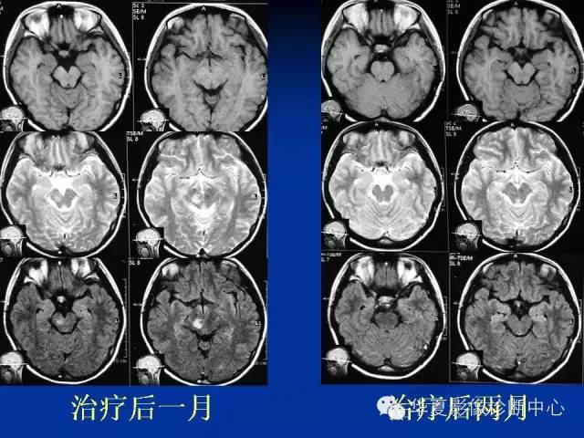颅脑肿瘤MR诊断与鉴别诊断