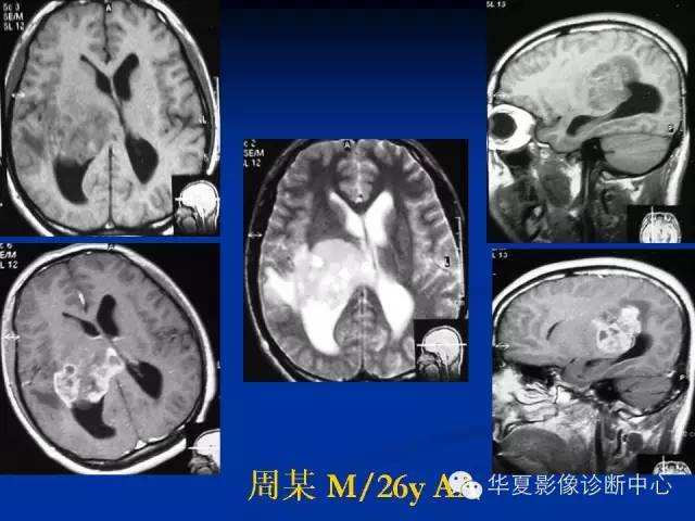 颅脑肿瘤MR诊断与鉴别诊断