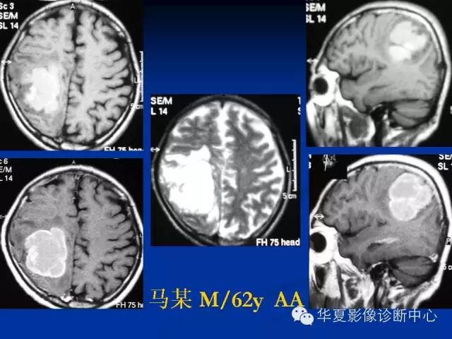颅脑肿瘤MR诊断与鉴别诊断