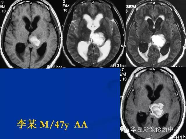 颅脑肿瘤MR诊断与鉴别诊断