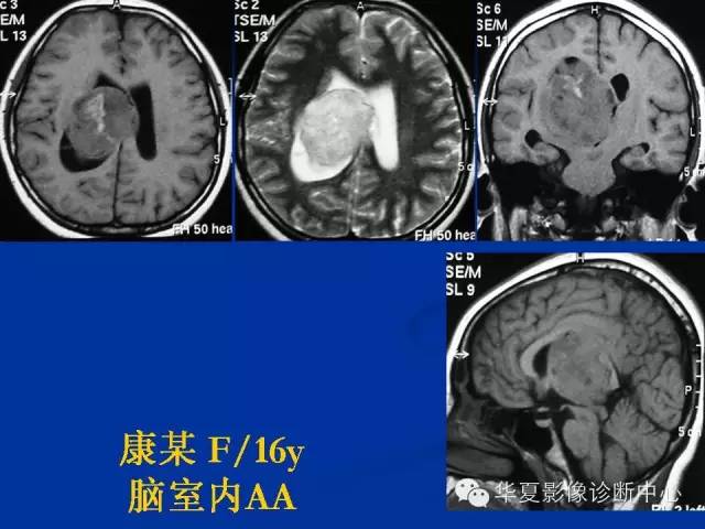 颅脑肿瘤MR诊断与鉴别诊断