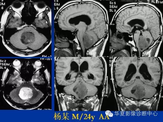 颅脑肿瘤MR诊断与鉴别诊断