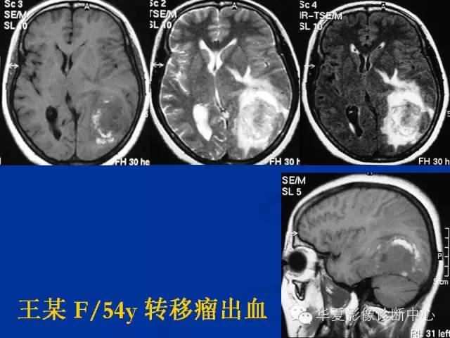 颅脑肿瘤MR诊断与鉴别诊断