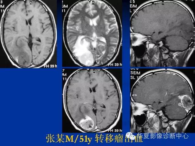 颅脑肿瘤MR诊断与鉴别诊断