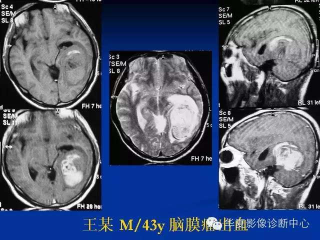 颅脑肿瘤MR诊断与鉴别诊断